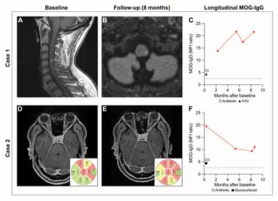 Case report: Concurrent MOG antibody-associated disease and latent infections in two patients